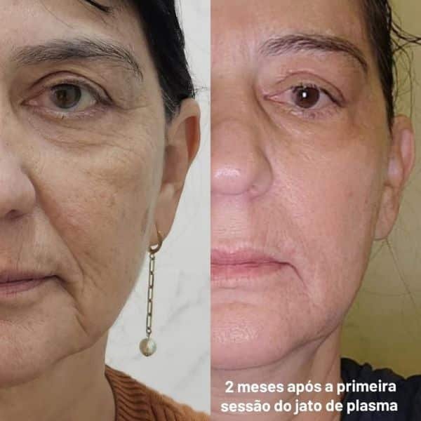 antesedepois11