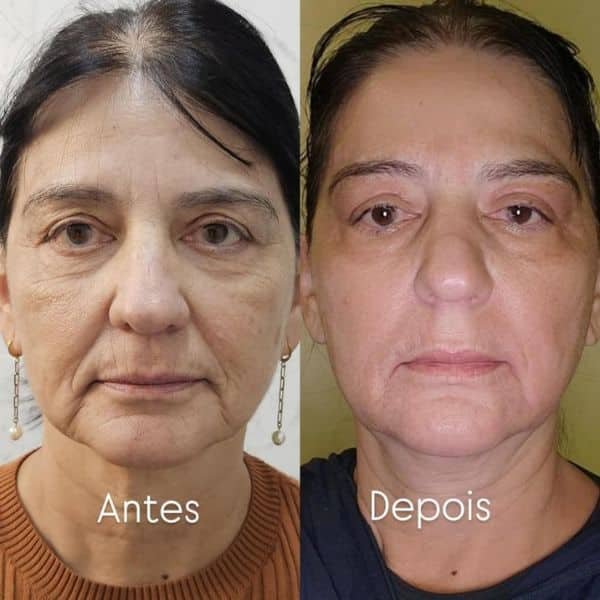 antesedepois12
